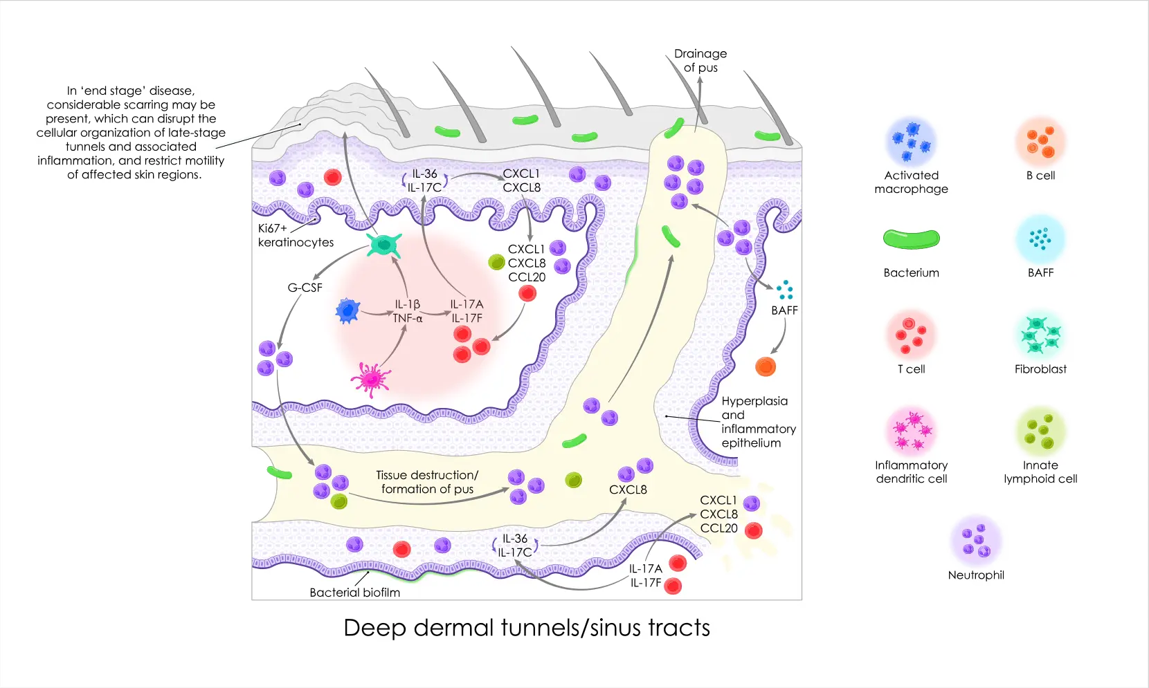 Deep dermal tunnels/sinus tracts